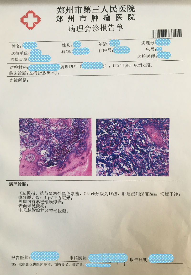 【我是黑色素瘤专家,我来讲(十四)】如何看懂黑色素瘤病理报告?