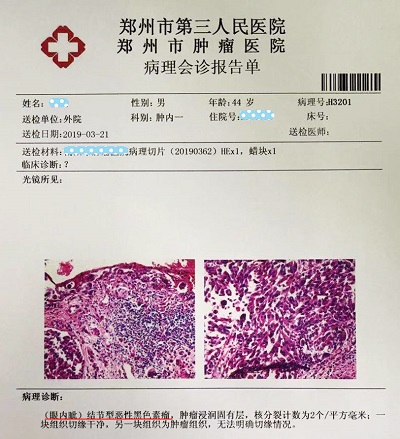 【关注前沿】针尖大的眼中"钉" 实则危险的黑色素瘤