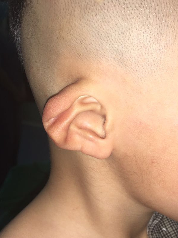 出生时,他的右耳折叠畸形,天真可爱的他时时会在意像宝宝一样蜷起来的